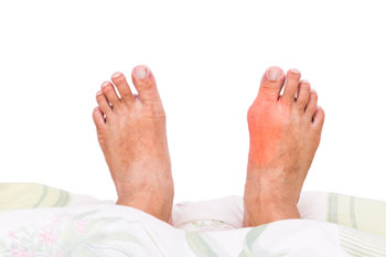 bunions prevention