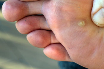 plantar wart