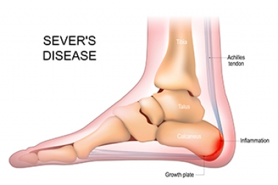 Sever’s Disease Affects Young Feet