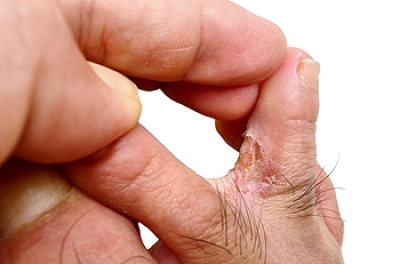 Exploring Causes and Symptoms of Athlete’s Foot